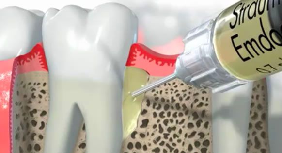 ②歯周組織再生療法