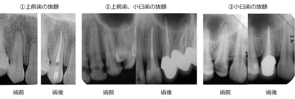 上前歯と小臼歯の抜髄