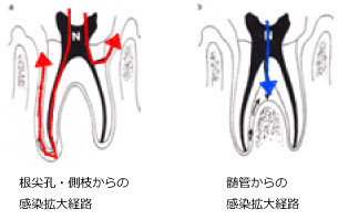 根尖孔と側枝と髄管からの感染拡大経路