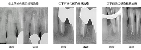 上前歯と下前歯の感染根管治療