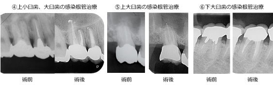 上小臼歯と大臼歯の感染根管治療
